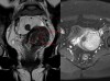 Hình ảnh chụp MRI khối u xơ tử cung lớn
