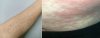 Tổn thương da thường gặp trong bệnh COVID-19