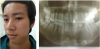 Nang xương hàm do răng - thủ phạm phá hủy xương thầm lặng cần phát hiện sớm