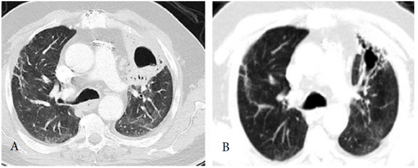 A: CT ngực của bệnh nhân cho thấy có một tổn thương hang ở thùy trên bên trái vào tuần 12 sau nhiễm COVID. B: CT cho thấy thoái triển tổn thương sau 6 tuần điều trị kháng sinh. (From archives of Aydın Yılmaz)
