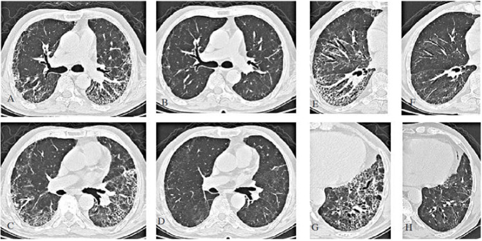a-c-e-g: CT ngực của bệnh nhân có biểu hiện khó thở ở tuần 13 sau nhiễm COVID-19. b-d-f-h: Sự thoái lui đáng kể các tổn thương tuần thứ 25 sau khi điều trị bằng steroid. (From archives of Aydın Yılmaz)