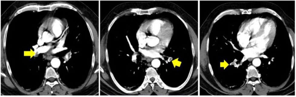 CT ngực của một bệnh nhân với đau ngực và độ bão hòa oxy thấp 8 tuần hậu COVID cho thấy hình ảnh thuyên tắc phổi hai bên