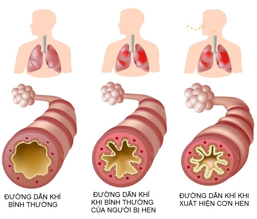 Tình trạng phổi và đường dẫn khí của người bị hen suyễn