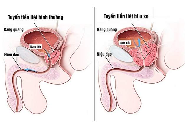 Hình 1 Hình ảnh mô tả tình trạng tăng sinh lành tính tuyến tiền liệt