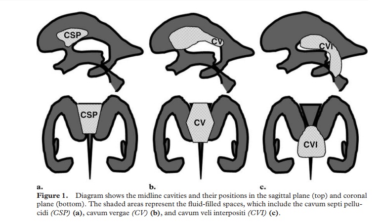 Tương quan vị trí không gian giữa các cấu trúc CSP, CV, CVI và các não thất bên, 3, 4