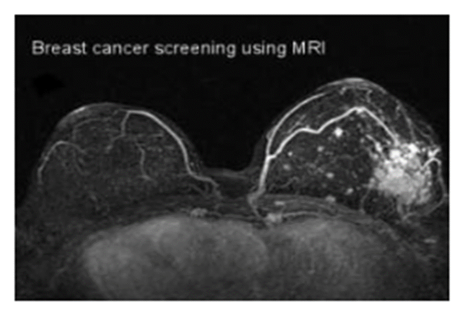 Khối ung thư vú trái trên MRI