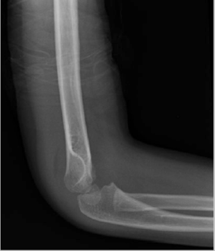 Hình 1: Gãy trên lồi cầu xương cánh tay Gartland độ I với bất thường vỏ xương và dấu hiệu bờm mỡ ở phía sau (Courtesy of Stephanie A. Russo, MD)