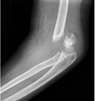 Hình 4: Gãy trên lồi cầu xương cánh tay độ III với sự di lệch hoàn toàn đầu gãy xa ( (Courtesy of Joshua M. Abzug, MD)