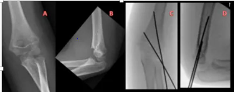 Hình 3.1.2: A,B :Phim chụp khớp khuỷu ở bệnh nhân nam 5 tuổi gãy trên lồi cầu xương cánh tay Gartland IIb . C,D: Phim sau chụp của cùng bệnh nhân, sử dụng hai đinh Kirschner phía ngoài 