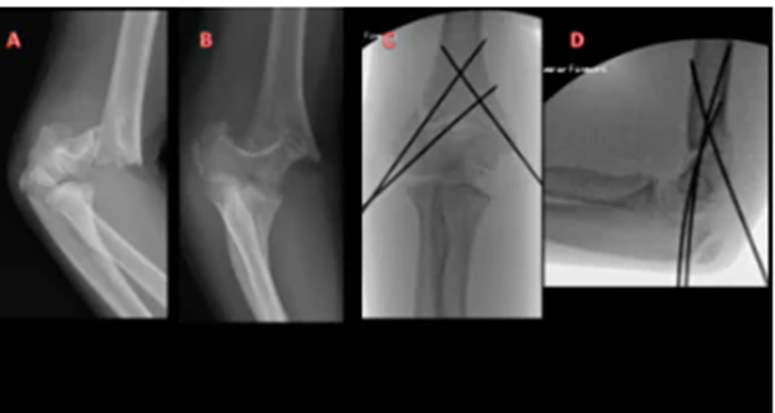 Hình 3.1.3: A,B : Phim chụp khớp khuỷu bệnh nhân nữ 10 tuổi gãy trên lồi cầu xương cánh tay độ III. C,D: Phim trong mổ của cùng bệnh nhân nắn chỉnh và cố định ổ gãy. Hai đinh Kirschner được sử dụng để làm vững cột ngoài, và một đinh Kirschner sử dụng để làm vững cột trong 