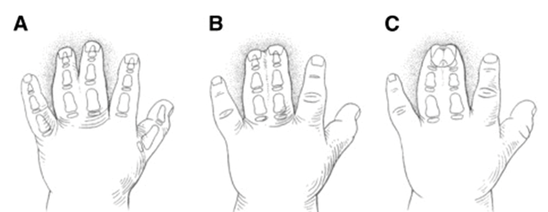 Hình 3: Các dạng dính ngón (A: đơn giản, không hoàn toàn; B: đơn giản, hoàn toàn; C: phức tạp)