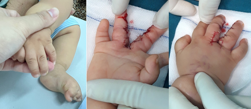 Hình 5: Dính ngón 3-4 hoàn toàn trước và sau phẫu thuật ở trẻ 12 tháng tuổi