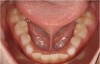 Dị tật thắng lưỡi bám thấp ở trẻ em cần phát hiện, điều trị sớm