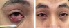 Viêm kết mạc cấp (Bệnh đau mắt đỏ)