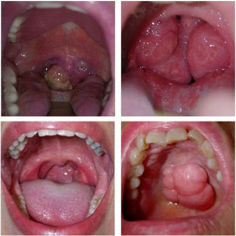 Hình 1. Ung thư vòm mũi họng