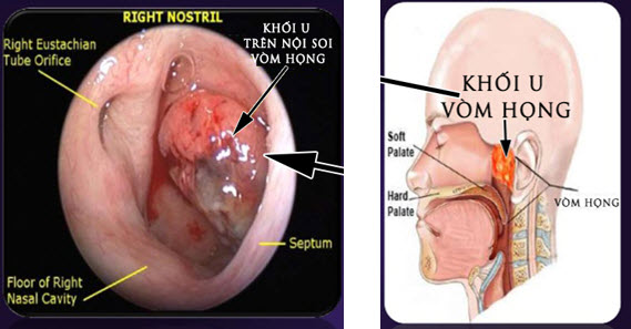 Hình 2. Hình ảnh nội soi khối u vòm họng