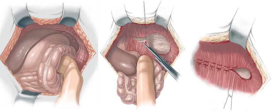 Hình 3. Hình ảnh mô tả phương pháp phẫu thuật thoát vị cơ hoành