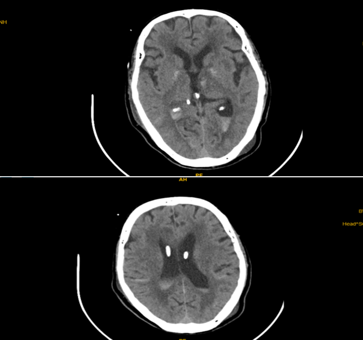 CT sọ não sau bơm 3 liều Alteplase