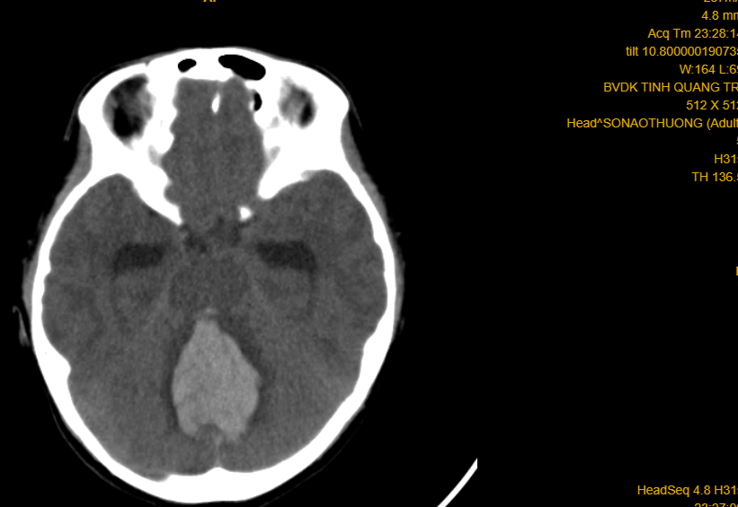 Phim CT-scan trường hợp số 02 (cháu gái 10 tuổi) xuất huyết não