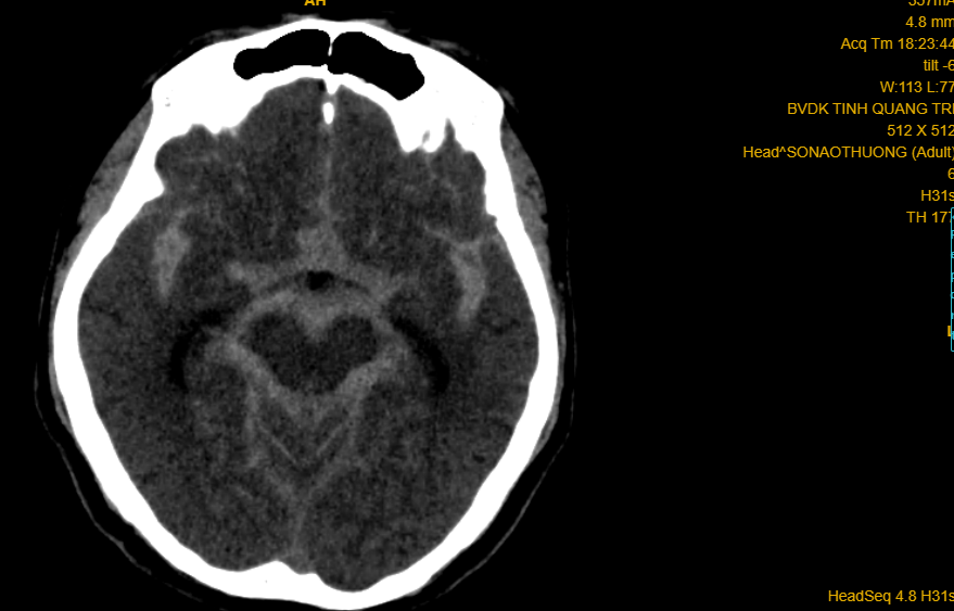 Phim CT-scan trường hợp số 01 (doanh nhân 57 tuổi) xuất huyết não