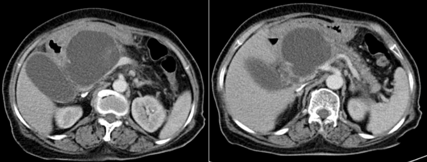 Hình 1 và 2. CT scan ngày 24/11 nang đầu tụy 8x7cm chèn ép ống mật chủ gây gãn nhẹ đường mật trong gan