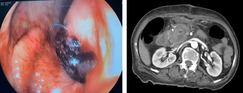 Hình 3 và 4. Hình ảnh chảy máu trong nang (nội soi) và CT scan ngày 15/12