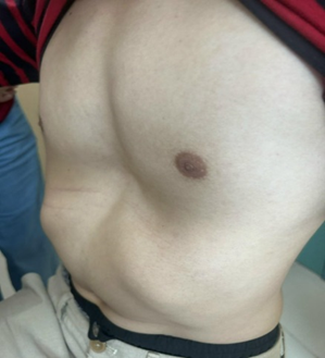 Hình 1: Một trường hợp lõm ngực