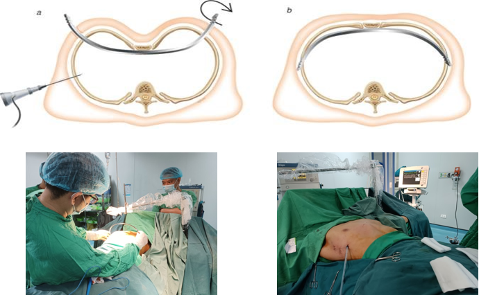 Hình 2: Thực hiện phẫu thuật Nuss tại BVĐK tỉnh Quảng Trị