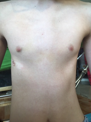Hình 3: HÌnh dáng Lồng ngực được khôi phục sau 1 tháng