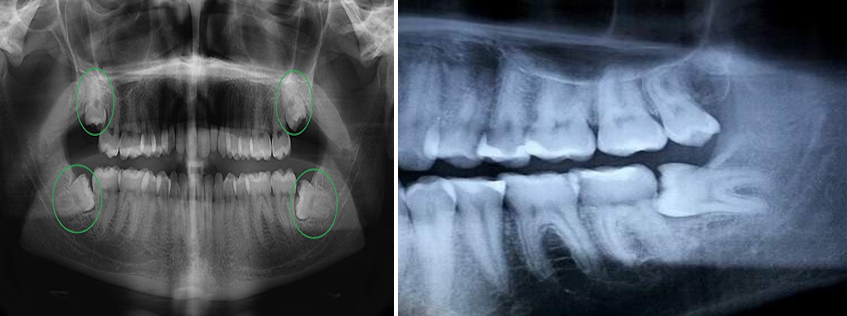 Hình ảnh X-quang răng số 8 mọc lệch