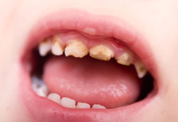 Đối với răng sữa nếu nhổ quá sớm trước thời kỳ thay răng thì có thể ảnh hưởng đến sự phát triển răng vĩnh viễn sau này
