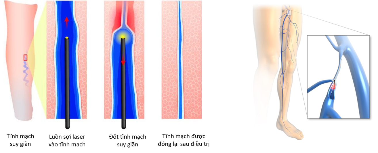 Cơ chế đốt laser nội mạch điều trị suy tĩnh mạch chi dưới