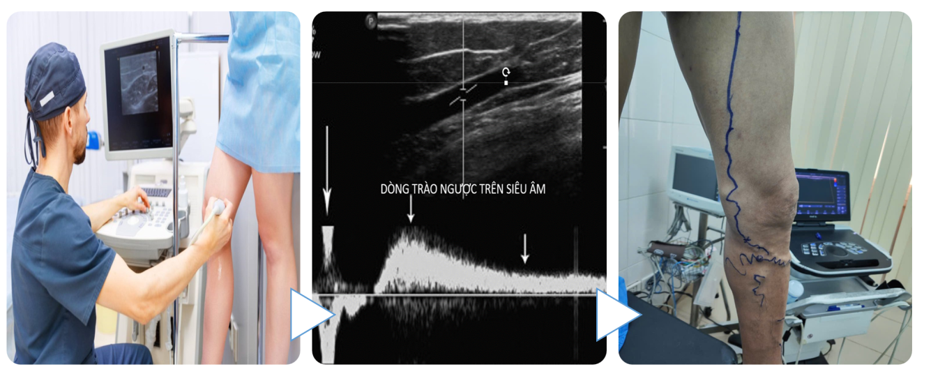 Siêu âm Doppler là phương pháp hiện đại, giúp phát hiện suy tĩnh mạch chi dưới